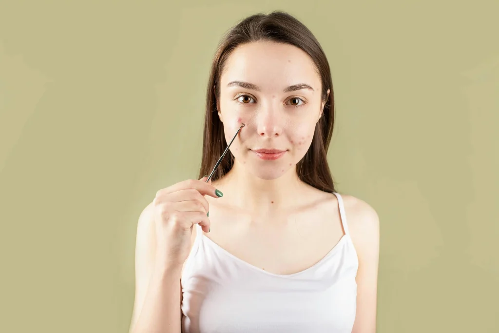 Jak dbać o cerę trądzikową?